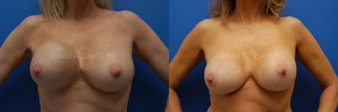 Breast Implant Revision Before and After | Sayah Institute