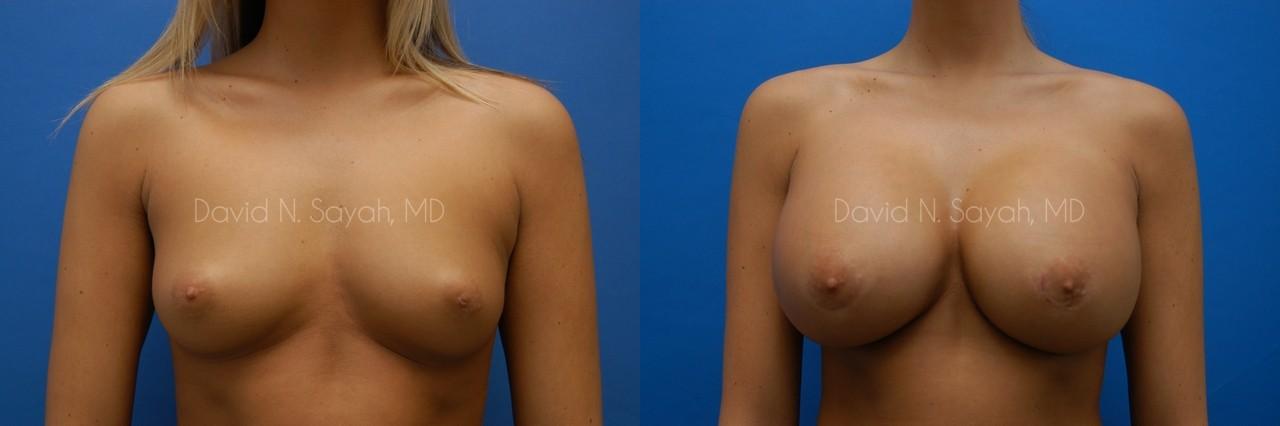 Breast Augmentation Before and After | Sayah Institute
