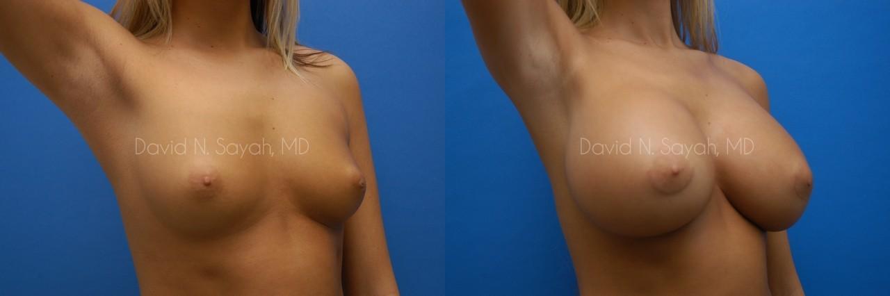 Breast Augmentation Before and After | Sayah Institute