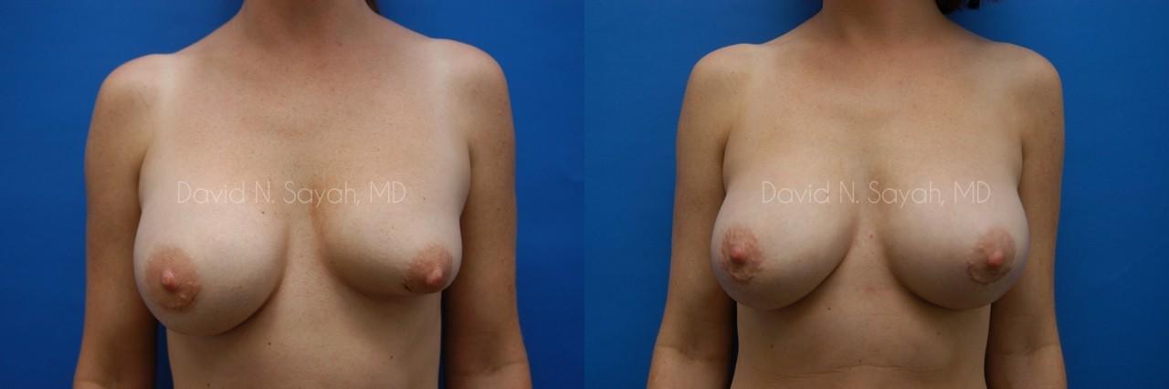 Breast Implant Revision Before and After | Sayah Institute
