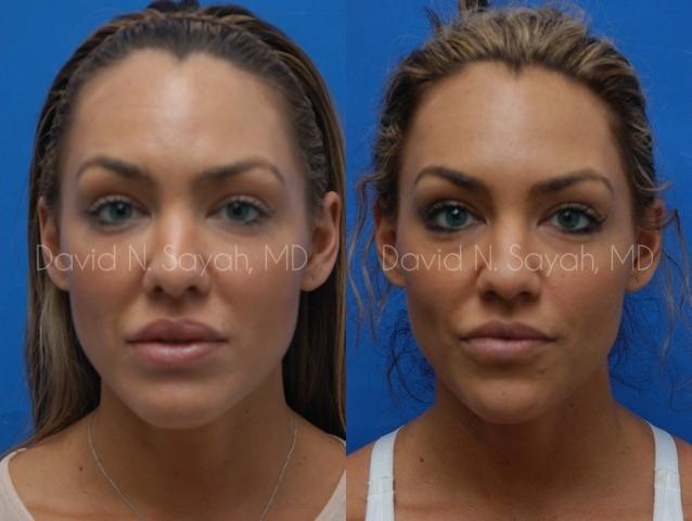 Rhinoplasty Before and After | Sayah Institute