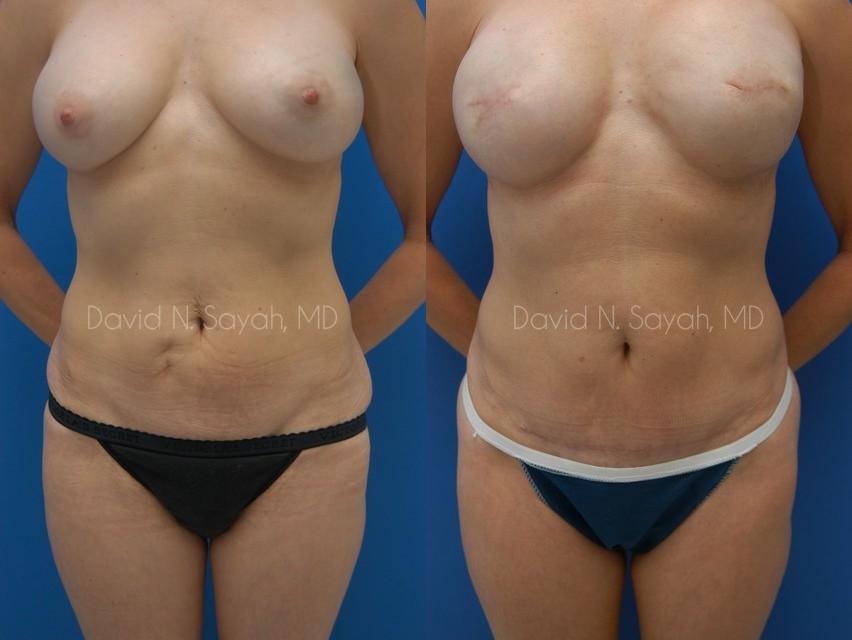 Mini Tummy Tuck Before and After | Sayah Institute