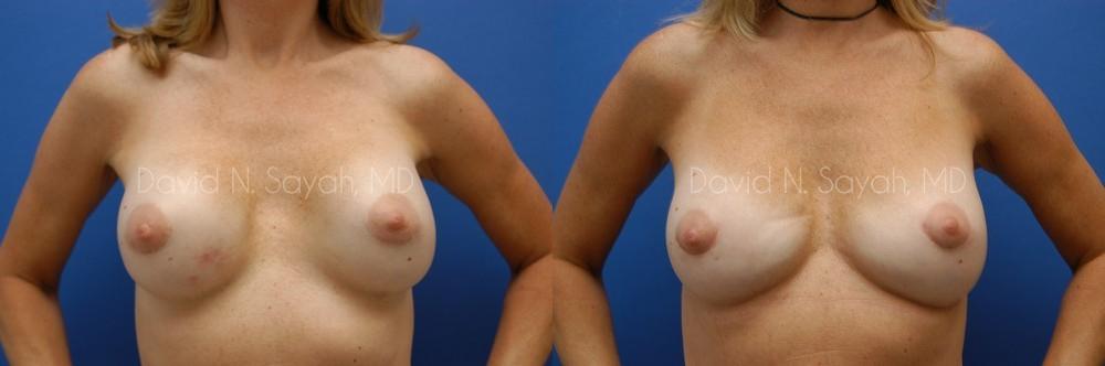 Breast Implant Revision Before and After | Sayah Institute