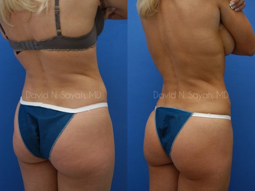 Liposuction Before and After | Sayah Institute