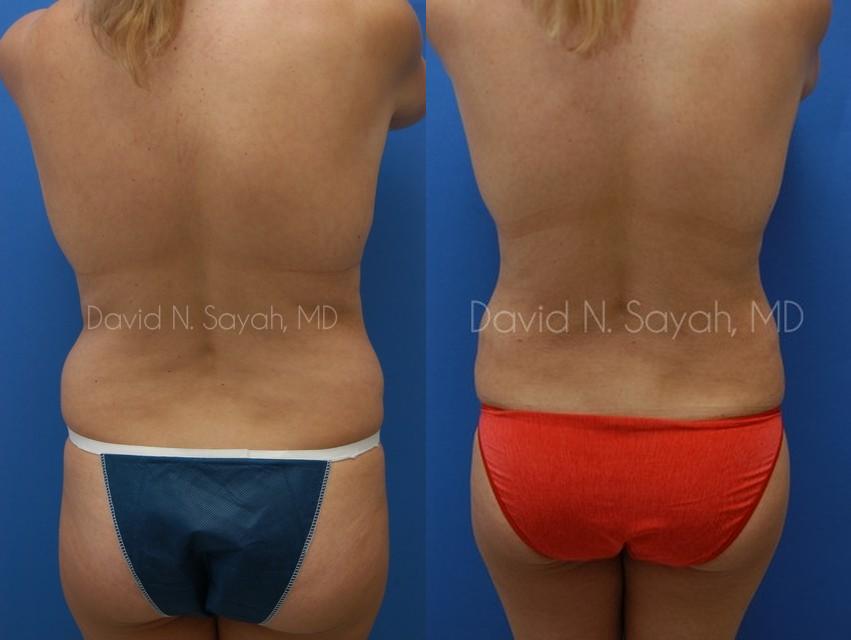 Liposuction Before and After | Sayah Institute