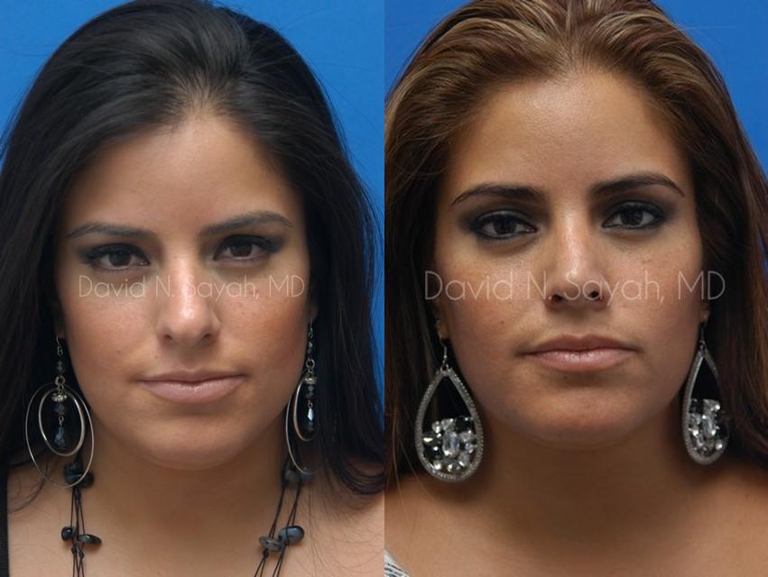 Rhinoplasty Before and After | Sayah Institute
