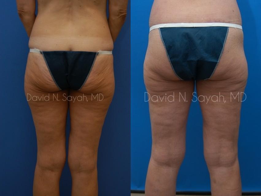 Buttock Lift Before and After | Sayah Institute