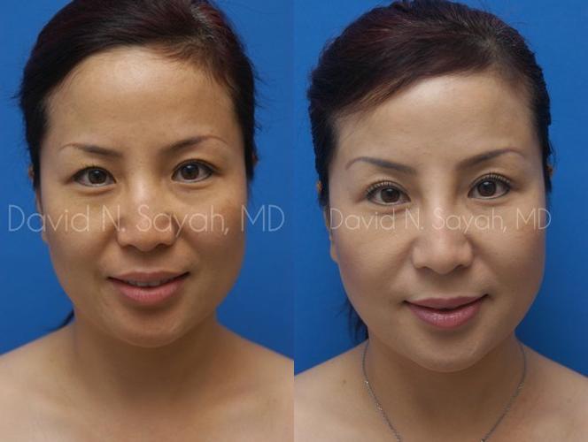 Eyelid Surgery Before and After | Sayah Institute
