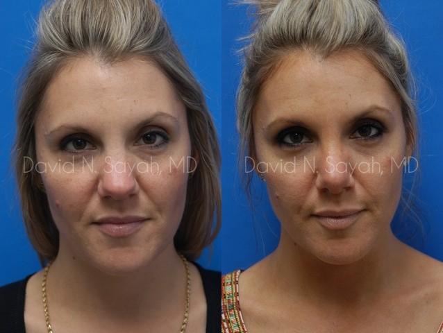 Rhinoplasty Before and After | Sayah Institute