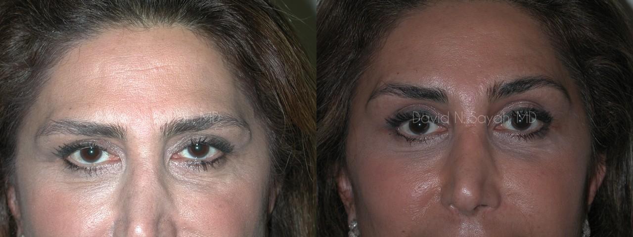 Brow Lift Before and After | Sayah Institute