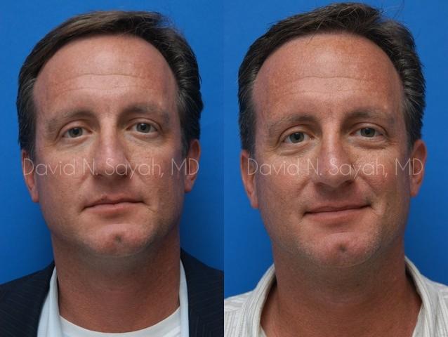 Rhinoplasty Before and After | Sayah Institute