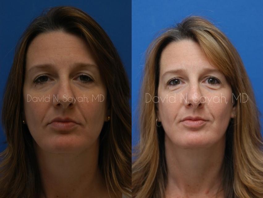 Rhinoplasty Before and After | Sayah Institute