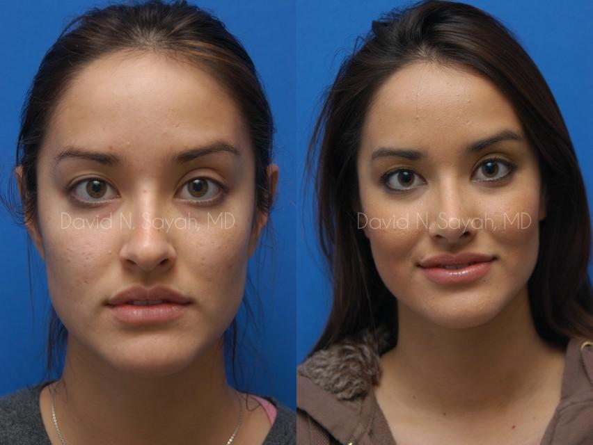 Rhinoplasty Before and After | Sayah Institute