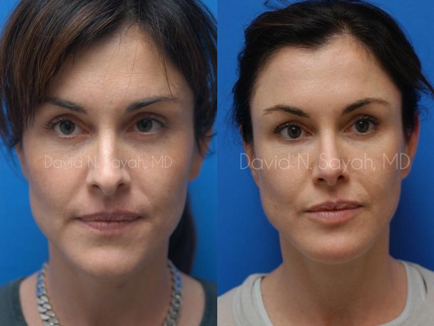 Chin Implant Before and After | Sayah Institute