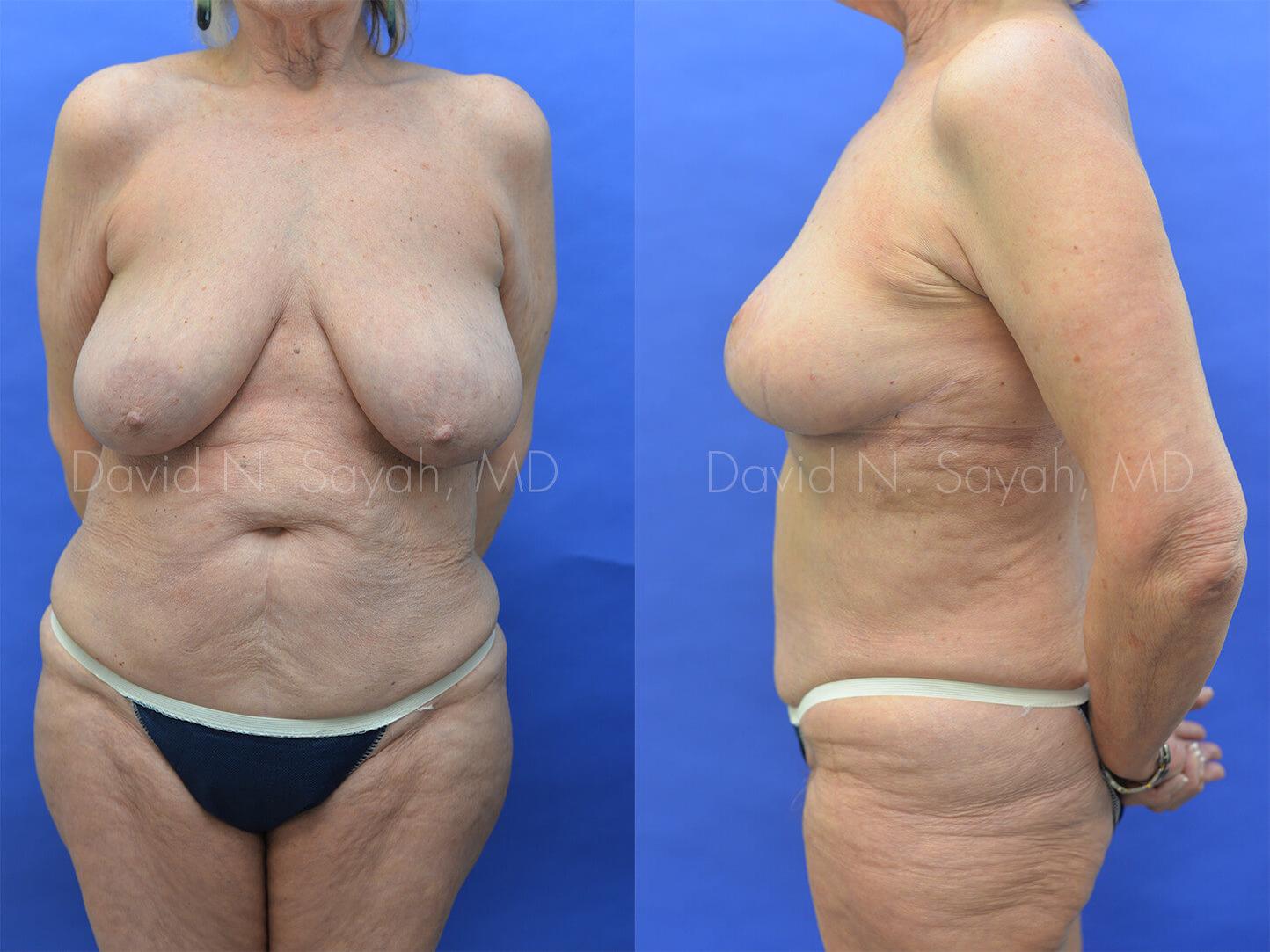 Breast Reduction Before and After | Sayah Institute