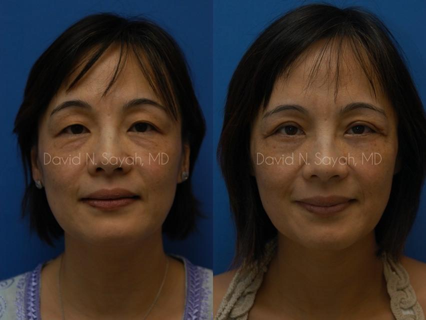 Eyelid Surgery Before and After | Sayah Institute