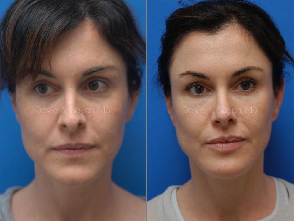 Rhinoplasty Before and After | Sayah Institute