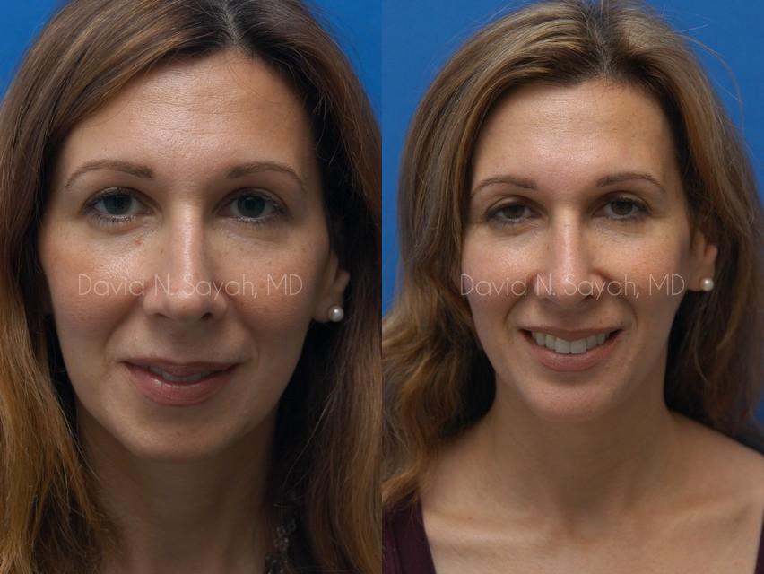 Rhinoplasty Before and After | Sayah Institute