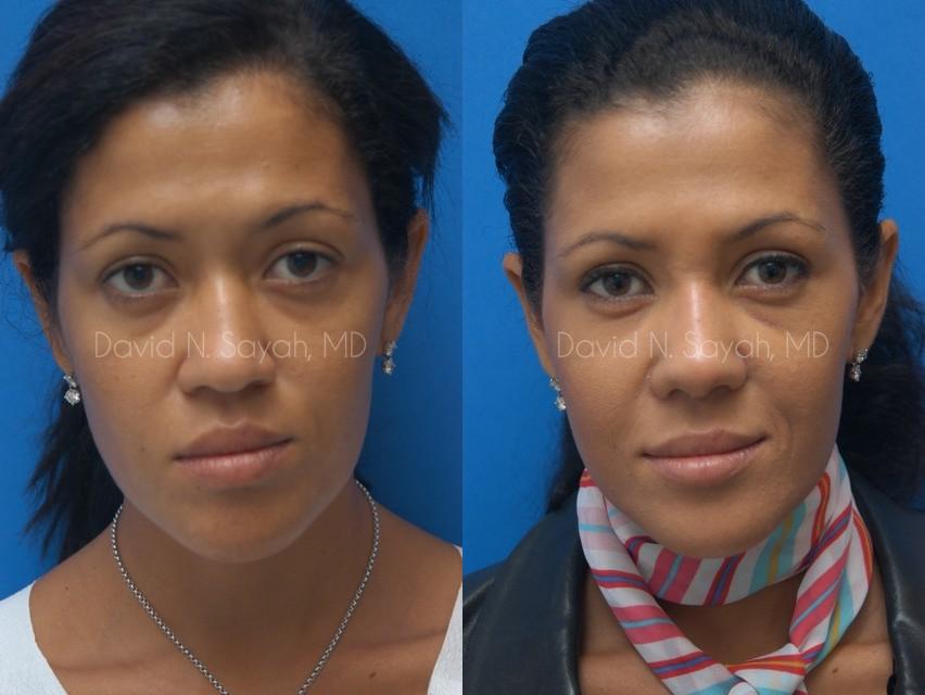 Rhinoplasty Before and After | Sayah Institute