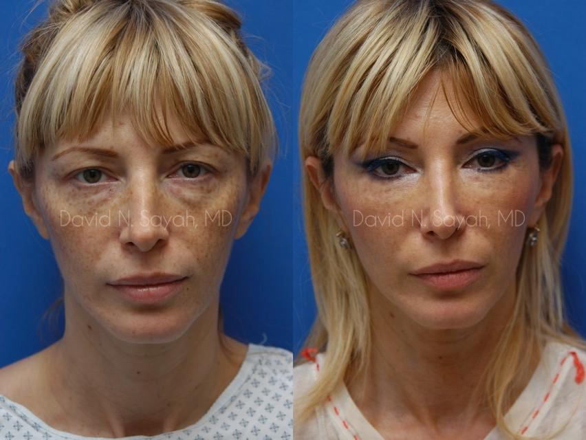 Eyelid Surgery Before and After | Sayah Institute