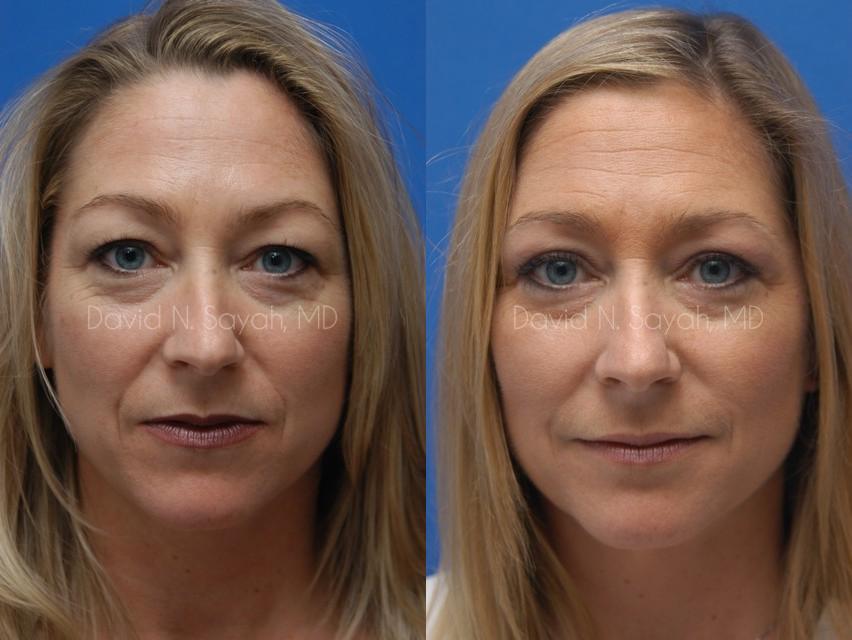 Eyelid Surgery Before and After | Sayah Institute