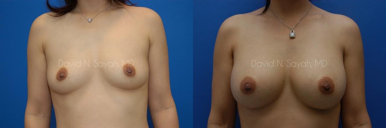 Breast Augmentation Before and After | Sayah Institute