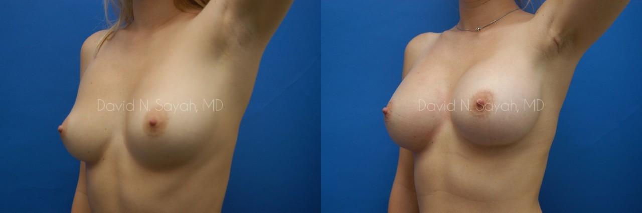 Breast Augmentation Before and After | Sayah Institute