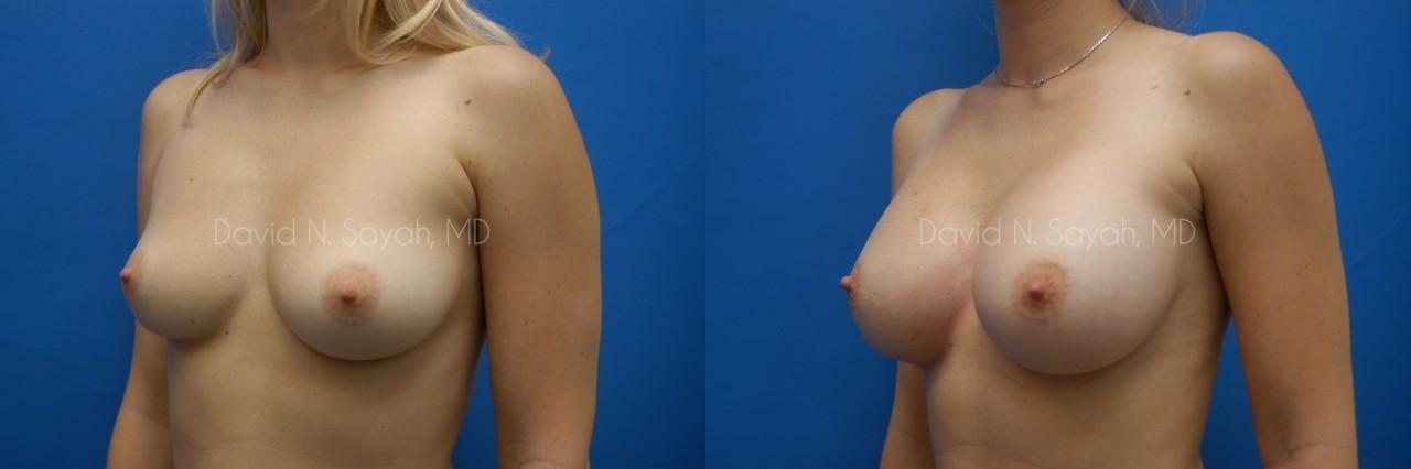 Breast Augmentation Before and After | Sayah Institute