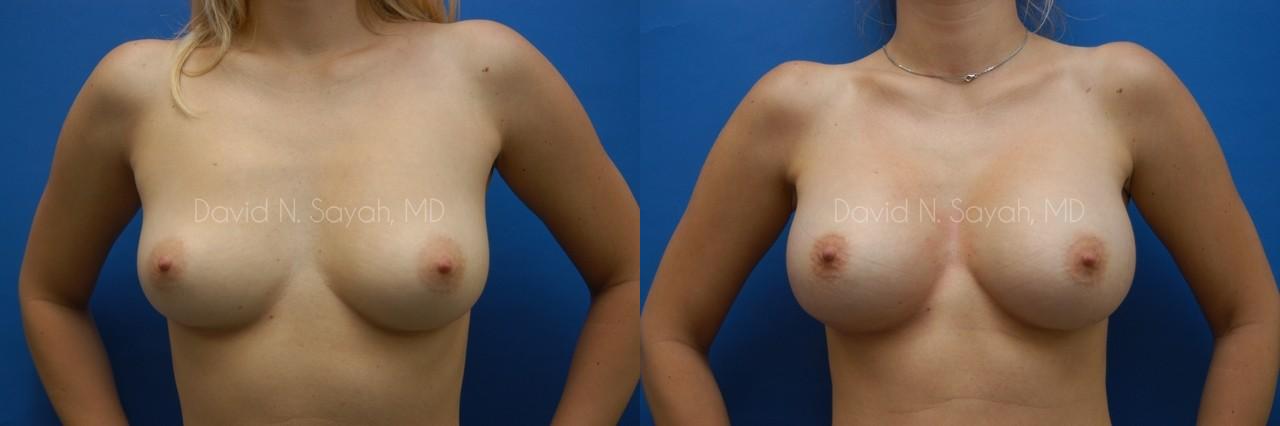 Breast Augmentation Before and After | Sayah Institute