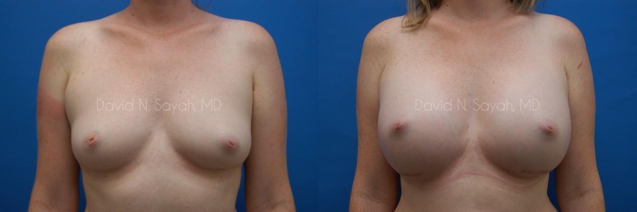 Breast Augmentation Before and After | Sayah Institute