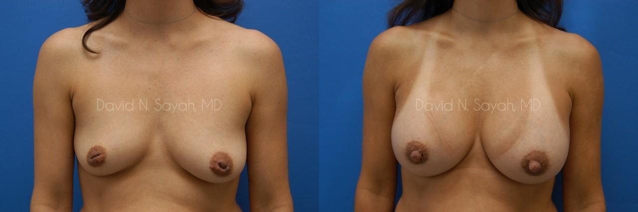 Breast Augmentation Before and After | Sayah Institute