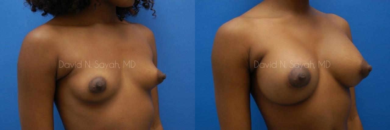 Breast Augmentation Before and After | Sayah Institute