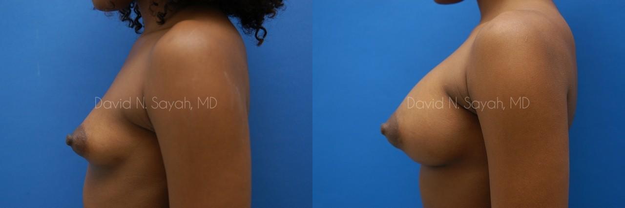 Breast Augmentation Before and After | Sayah Institute