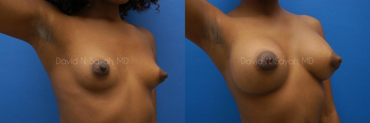 Breast Augmentation Before and After | Sayah Institute