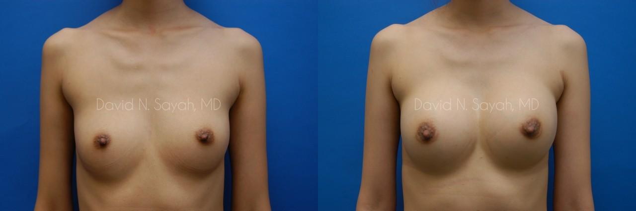 Breast Augmentation Before and After | Sayah Institute