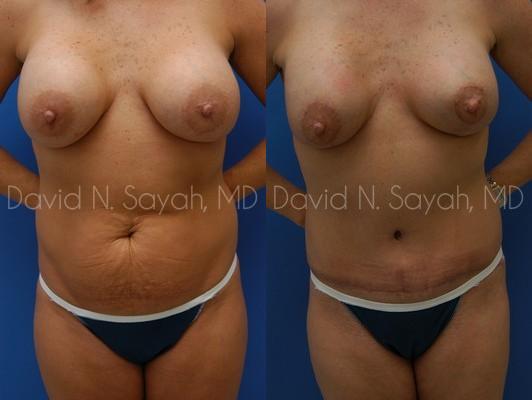 Tummy Tuck Before and After | Sayah Institute