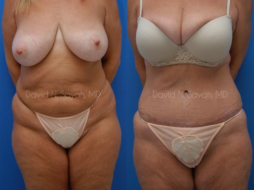 Tummy Tuck Before and After | Sayah Institute
