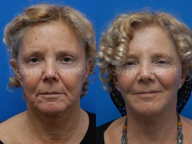 Facelift Before and After | Sayah Institute