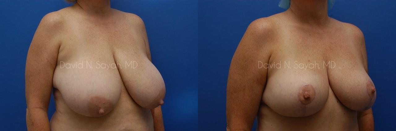 Breast Lift Before and After | Sayah Institute