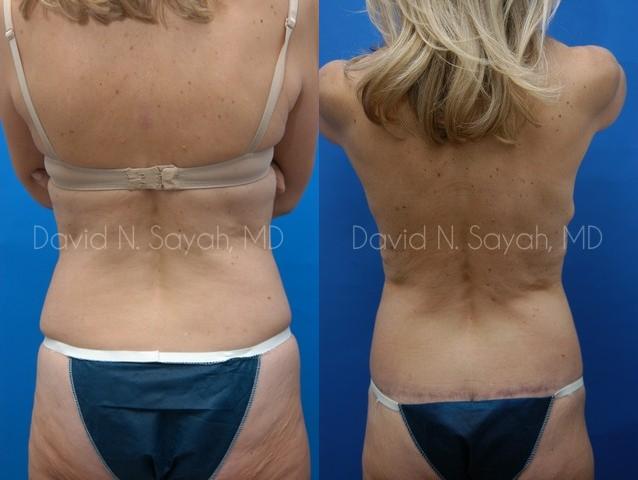 Back Tuck Belt Lipectomy Before and After | Sayah Institute