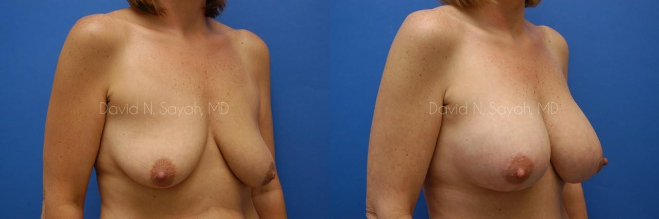 Breast Augmentation And Mastopexy Before and After | Sayah Institute