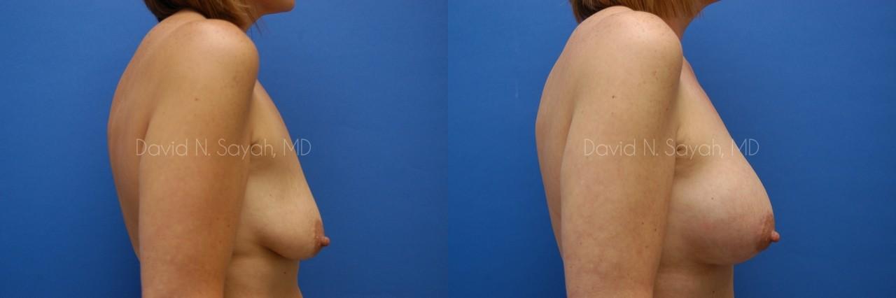 Breast Augmentation And Mastopexy Before and After | Sayah Institute