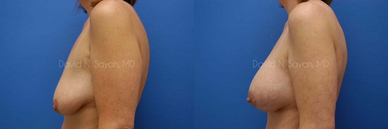 Breast Augmentation And Mastopexy Before and After | Sayah Institute