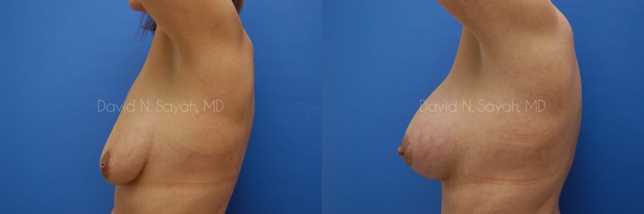 Breast Augmentation And Mastopexy Before and After | Sayah Institute