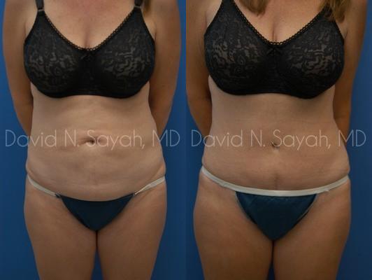 Tummy Tuck Before and After | Sayah Institute
