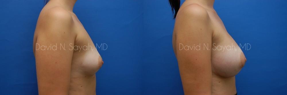Breast Augmentation Before and After | Sayah Institute