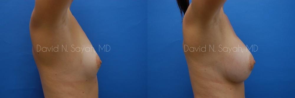 Breast Augmentation Before and After | Sayah Institute