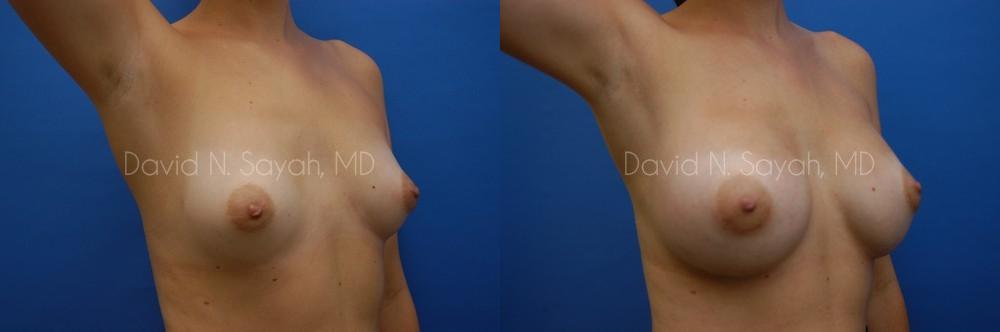Breast Augmentation Before and After | Sayah Institute