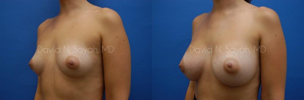 Breast Augmentation Before and After | Sayah Institute