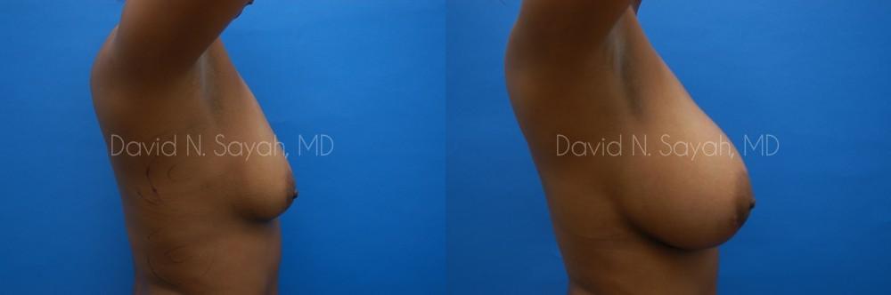 Breast Augmentation Before and After | Sayah Institute